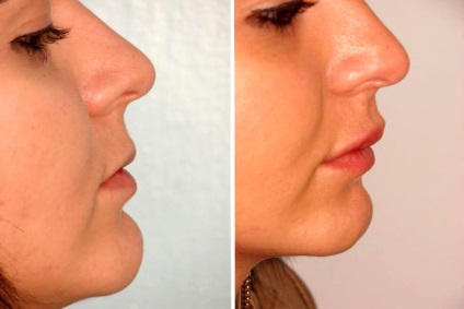 umpluturi contur Restylane (Restylane) Contur de umplere din plastic Restylane