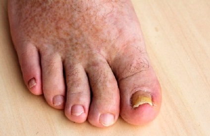 tratamentul mumiei ciupercii unghiilor de la picioare
