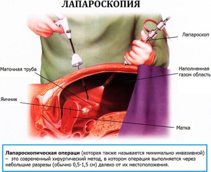 Polycystic ovare cauze, simptome, diagnosticul și tratamentul sindromului de ovar polichistic