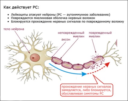 Consecințele sclerozei multiple - pericolul și riscul de boli