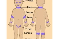 Cauzele eczeme (toate despre psoriazis) Cauzele eczeme