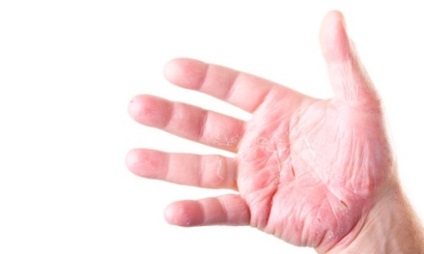 Cauzele eczeme (toate despre psoriazis) Cauzele eczeme