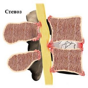 Cauze, simptome si tratamentul stenoza canalului spinal lombare și a coloanei cervicale