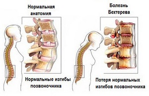 Cauze, simptome si tratamentul stenoza canalului spinal lombare și a coloanei cervicale