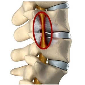 Cauze, simptome si tratamentul stenoza canalului spinal lombare și a coloanei cervicale