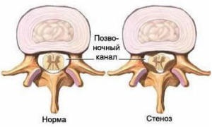 Cauze, simptome si tratamentul stenoza canalului spinal lombare și a coloanei cervicale