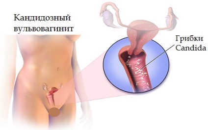 Simptome și metode de bază de tratament al candidozei vulvovaginale