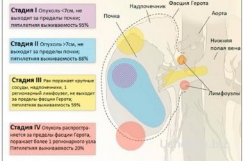 Simptomele care pot apărea din cauza cancerului renal (care) Simptomele care pot apărea din cauza cancerului renal