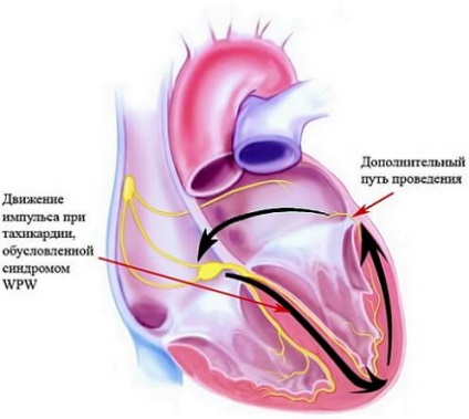 sindromul Wolff-Parkinson-White - tratament, simptomele, cauzele