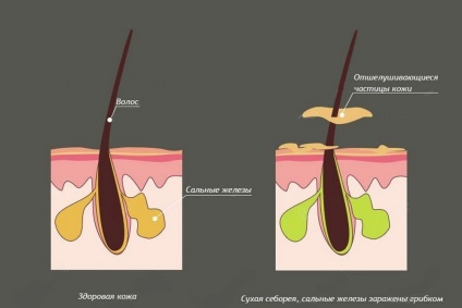 Dry fotografie dermatita, simptomele și tratamentul dermatitei uscat (dermatita) Dry fotografie dermatita, simptomele și tratamentul dermatitei uscat
