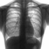 Tuberculoma pulmonară cauze, simptome, diagnostic si tratament - bisturiu - medical