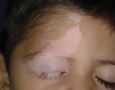 Cauzele si tratamentul vitiligo (vitiligo cauze de tratament) Cauze Vitiligo și tratament