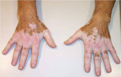 Cauzele Vitiligo și tratament (cauza) Cauze Vitiligo și tratament