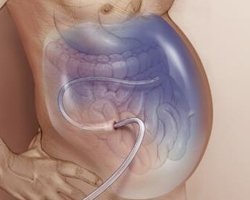 Ascită, cavitatea peritoneală în oncologie, cancerul de stomac și intestine, peritoneu kantseromatoze - Prognoza