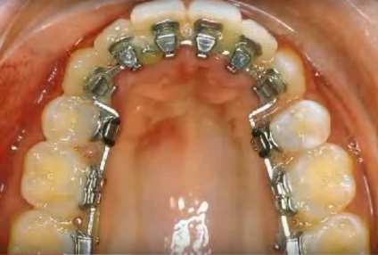 Lingual bretele cauzele și deficiențele de aparat dentar invizibil