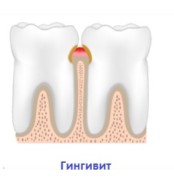 Lingual bretele cauzele și deficiențele de aparat dentar invizibil