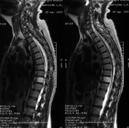 hemangiom a coloanei vertebrale (toracice, de col uterin și a coloanei vertebrale lombare) simptome, riscul de tratament
