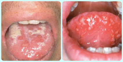 răni la rece pe fotografie limba (simptome ale limbii herpes) Leziuni la rece pe limba Foto