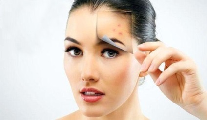 Cum de a elimina rapid roseata de la acnee - modalități eficiente