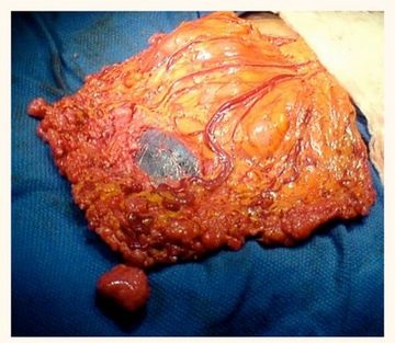 supraviețuire carcinomatoza peritoneala