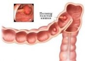 supraviețuire carcinomatoza peritoneala