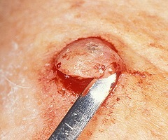 keratoacanfomul piele - clasificare, cauze, tratament