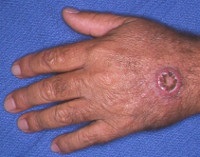 keratoacanfomul piele - cauze, simptome, diagnostic și tratament