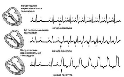 tahicardie supraventriculară cauze, simptome si tratament paroxism