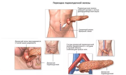 Noi, în tratamentul diabetului de tip 1 principalele directii ale terapiei