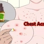 Papule-pustule acnee (acnee) - cum să scape de a elimina rapid cauzele si tratamentul