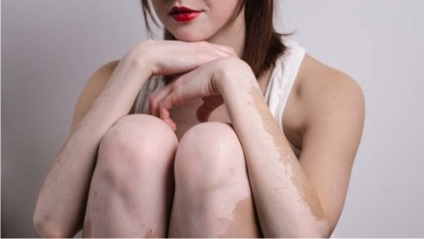Transmise dacă vitiligo contagioasă și, dacă pete albe