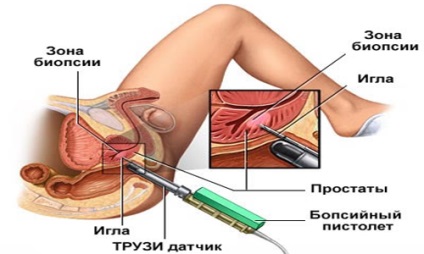 Trus-l de prostată, la fel ca și pregătirea pentru procedura