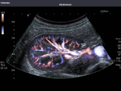 Uzi cavitatea peritoneală și spațiu retroperitoneal