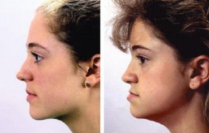 Malocclusion (dinți din partea inferioară superioară) malocluzia