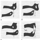 Tipuri de malocclusion și grade (mandibula superioară) Tipuri de malocclusion și grade