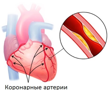Durere în inimă (durere de inimă) durere de inimă