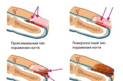 Decât pentru tratarea unghiilor ciuperca la copii (tratament) Decât pentru tratarea unghiilor ciuperca la copii