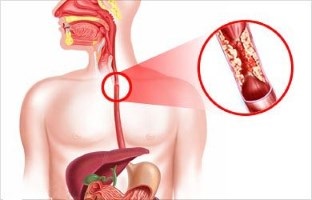 Distal sipotomy esofagita cronică și tratamentul diferitelor grade dieta (cronică) Distală sipotomy esofagita cronică și tratamentul de diferite grade, dieta