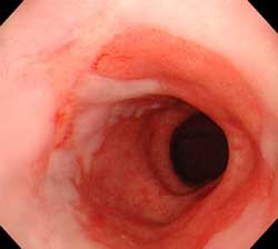 Distal sipotomy esofagita cronică și tratamentul diferitelor grade dieta (tratament) Distală sipotomy esofagita cronică și tratamentul de diferite grade, dieta