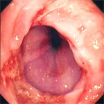 Distal sipotomy esofagita cronică și tratamentul diferitelor grade dieta (cronică) Distală sipotomy esofagita cronică și tratamentul de diferite grade, dieta