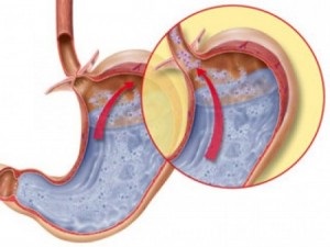 Distal sipotomy esofagita cronică și tratamentul diferitelor grade dieta (esofagite) Distală sipotomy esofagita cronică și tratamentul de diferite grade, dieta