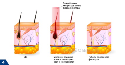 Acasă photoepilator - comentarii, un rating cumpăra mai bine în 2016 (acasă) Acasă photoepilator - comentarii, un rating cumpăra mai bine 2016