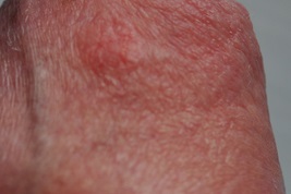 Din cauza a ceea ce inrosirea cap de sex masculin și mâncărime, infecții fungice (roșeață) Din cauza a ceea ce inrosirea cap de sex masculin și mâncărime, infecții fungice