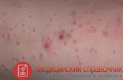 Molluscum contagiosum - fotografii, semne, îndepărtarea, tratamentul copiilor (tratament) Molluscum contagiosum - fotografii, semne, îndepărtarea, tratamentul copiilor