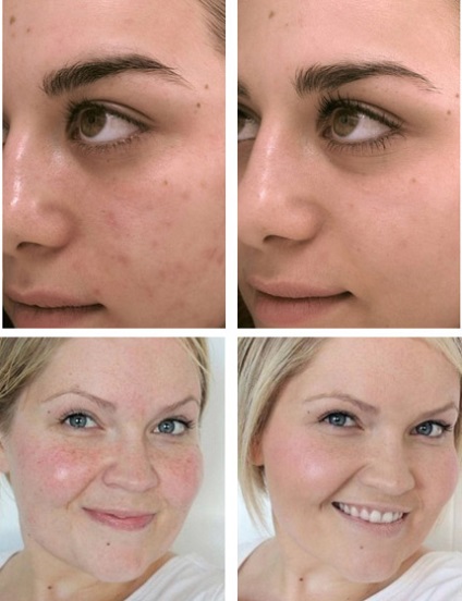 Mecanice faciale coji comentarii, lecturi, înainte și după fotografii, prețurile (de îngrijire) Mecanice faciale coji comentarii, lecturi, înainte și după fotografii, preturi