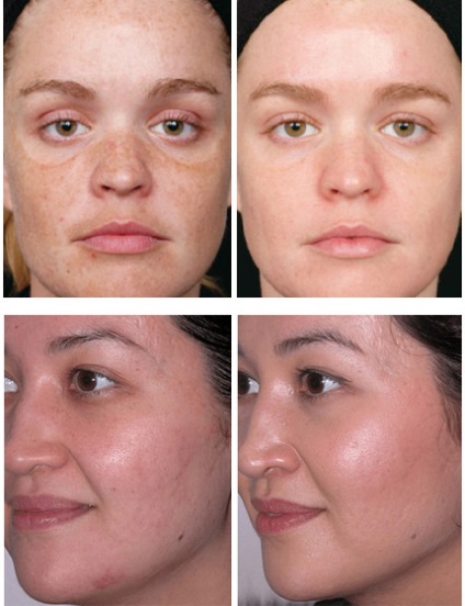 Mecanice faciale coji comentarii, lecturi, înainte și după fotografii, prețurile (de îngrijire) Mecanice faciale coji comentarii, lecturi, înainte și după fotografii, preturi