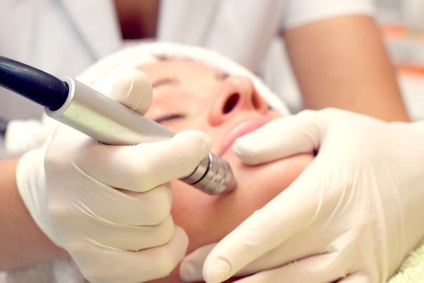 peeling mecanic - descrierea procedurii (mecanică) peeling mecanic - descrierea procedurii