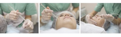 peeling mecanic - descrierea procedurii (procedura) peeling mecanic - descrierea procedurii
