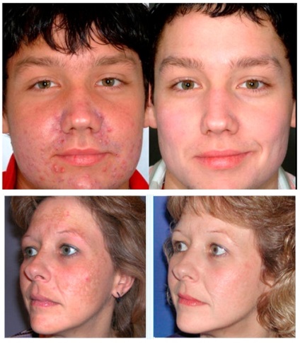 peeling mecanic - descrierea procedurii (peeling mecanic feței) peeling mecanic - descrierea procedurii