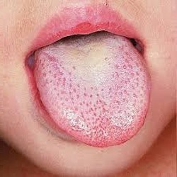 Млечница в устата при деца, лекувани с народни средства